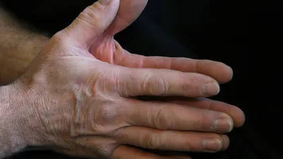 3 supplements for osteoarthritis: glucosamine, curcumin, and type II collagen