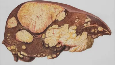 3 supplements for fatty liver disease: what the research actually shows