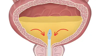 Thumbnail for Cystistat: Sodium Hyaluronate Bladder Instillation for Interstitial Cystitis